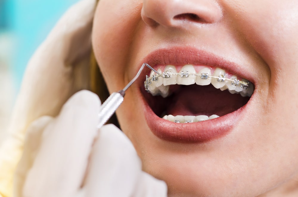 Orthodontic Treatment in Vasanth Nagar