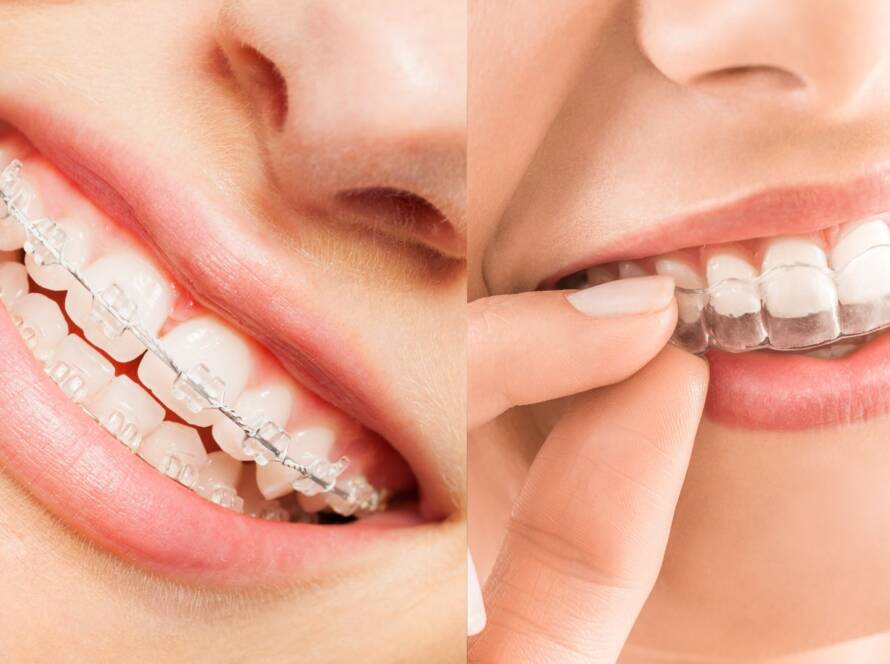Invisalign Treatment Near Mount Carmel College