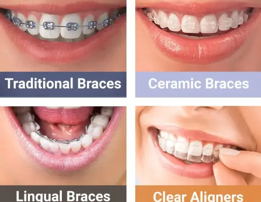 Braces for Adults