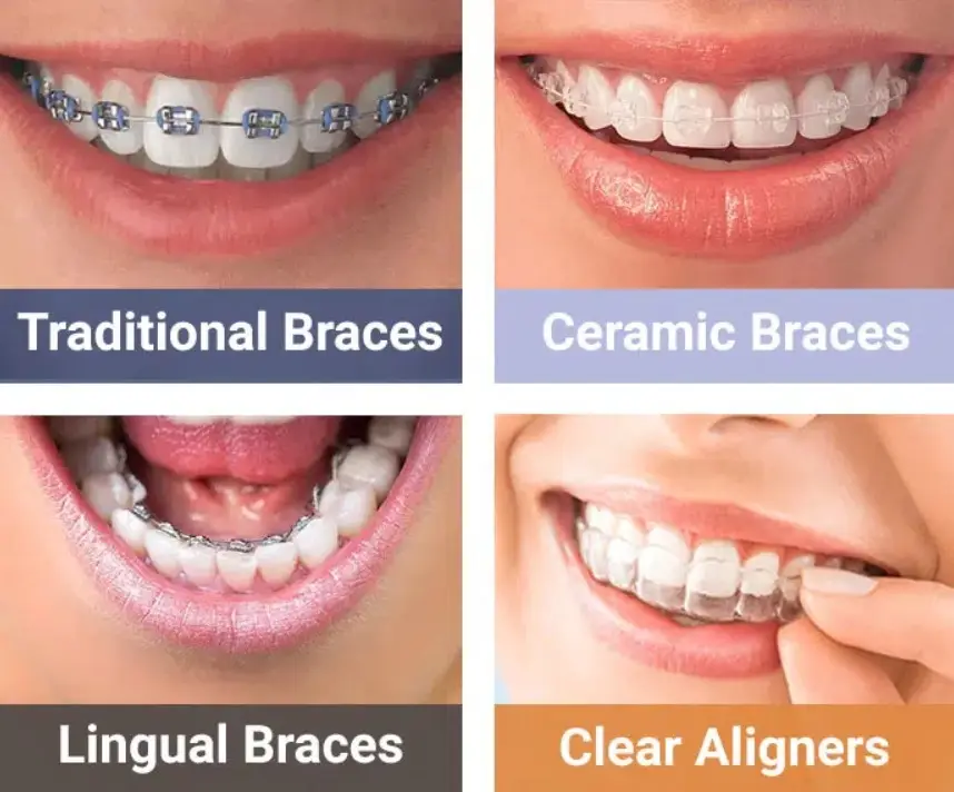 Braces for Adults