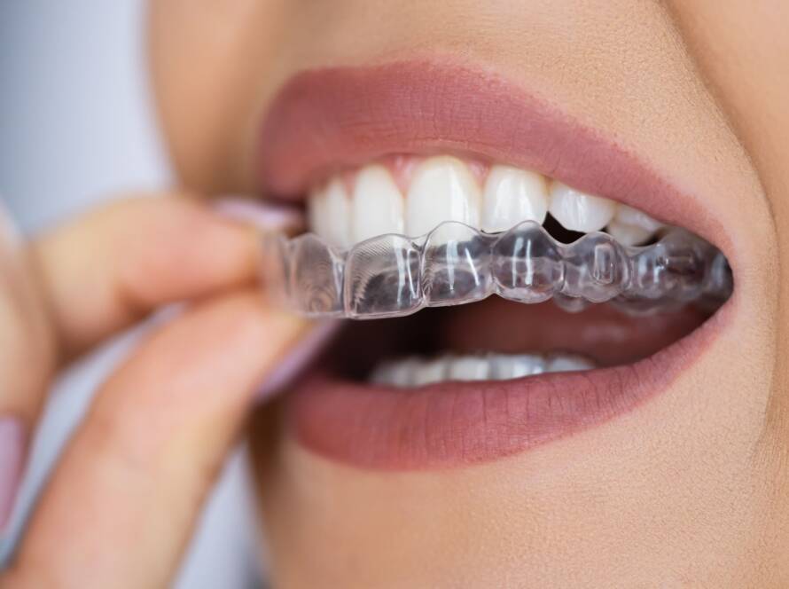 Spark Clear Aligners in Vasanth Nagar