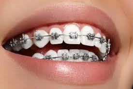 Damon Braces in Vasanth Nagar