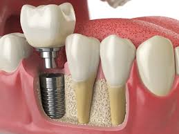 Root Canal Treatment in Vasanth Nagar