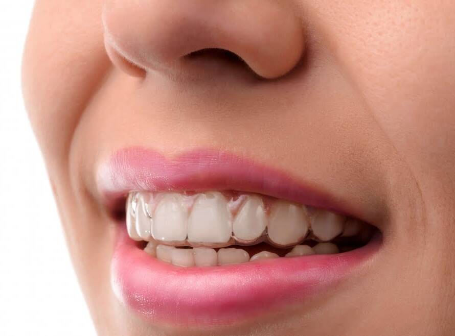 Invisalign cost