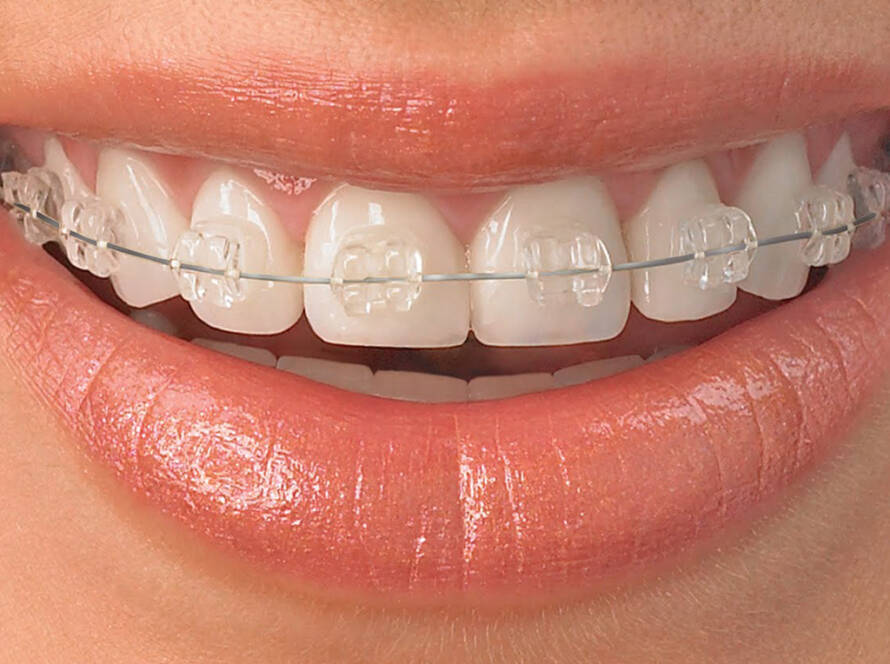 Ceramic Braces