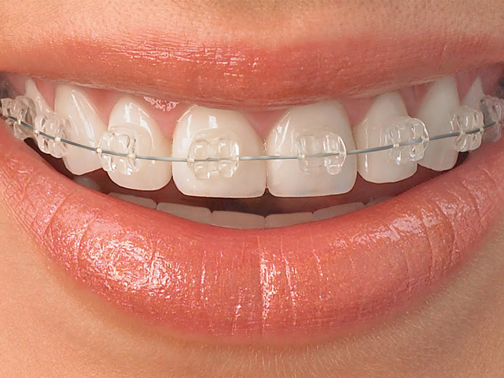 Ceramic Braces