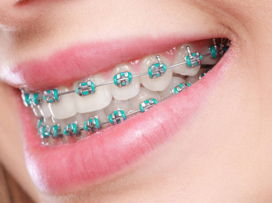 Braces