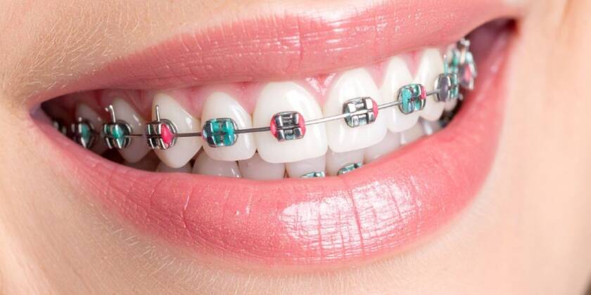 Braces