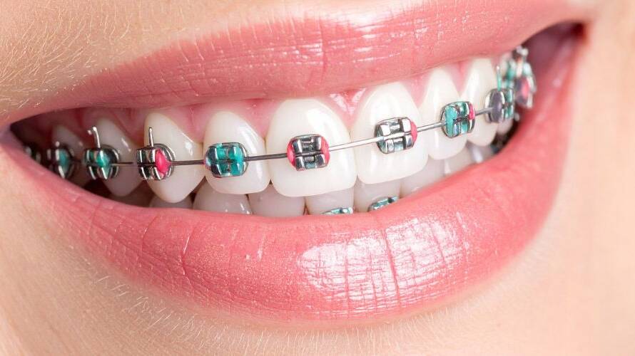 Braces