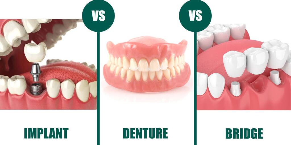Dental Implant Bridge Denture