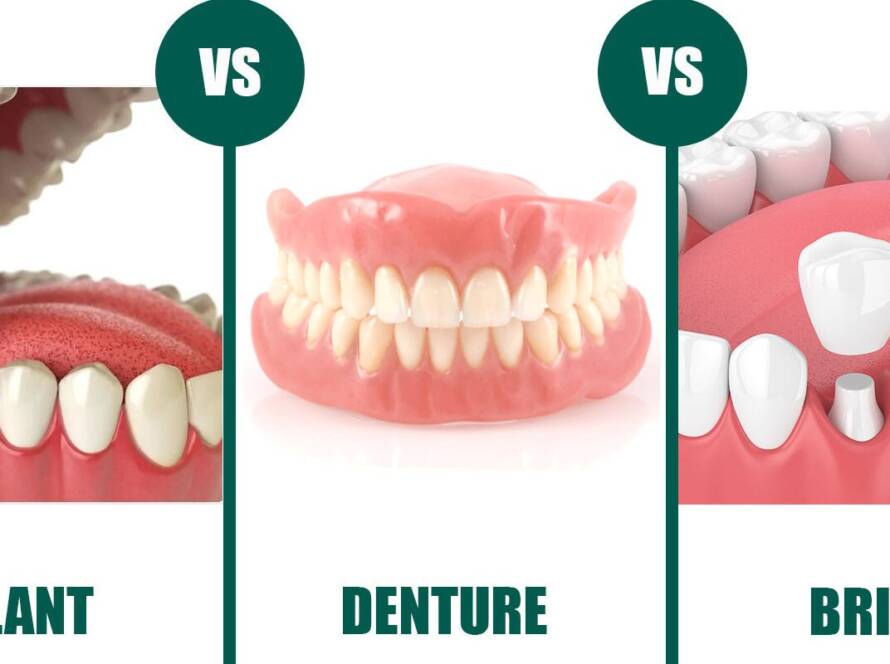 Dental Implant Bridge Denture