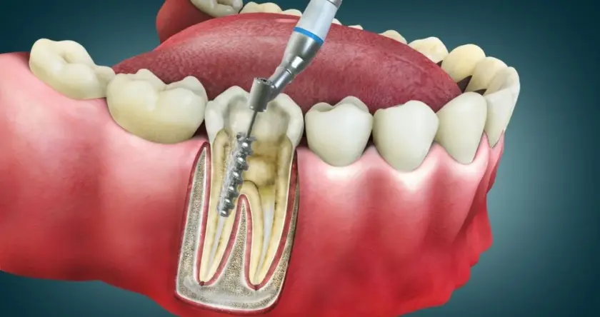 Root canal treatment
