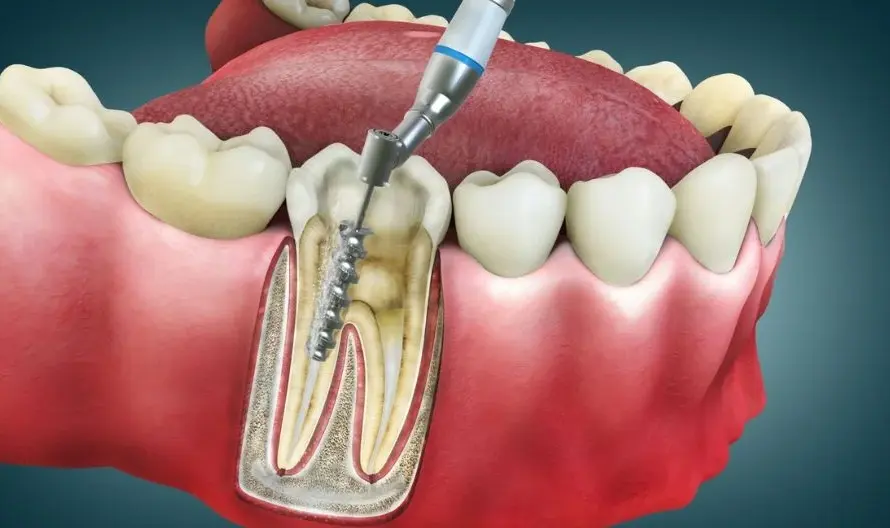 Root canal treatment