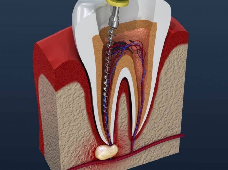 Root Canal