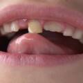 My Teeth Are Becoming Loose- Can the Dentist Save Them?