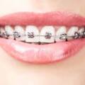Are Braces Painful?