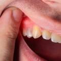 My Gums Are Swollen Near One Tooth- What Is Happening?
