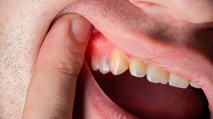 Gums