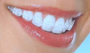 Invisible Braces