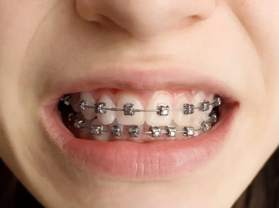 Damon Braces