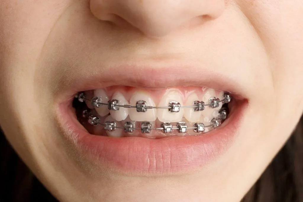 Damon Braces