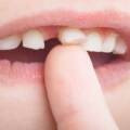 My Teeth Are Becoming Loose — Can the Dentist Save Them?
