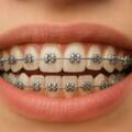 What is the cheapest option for braces on Lavelle Road?