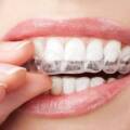 Who Needs Invisalign in Bangalore?