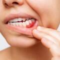My gums are swollen near one tooth- what is happening?