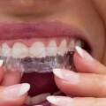 Who Should Wear Invisalign Aligners?