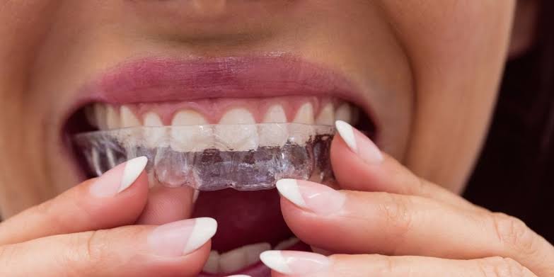 Invisalign Aligners