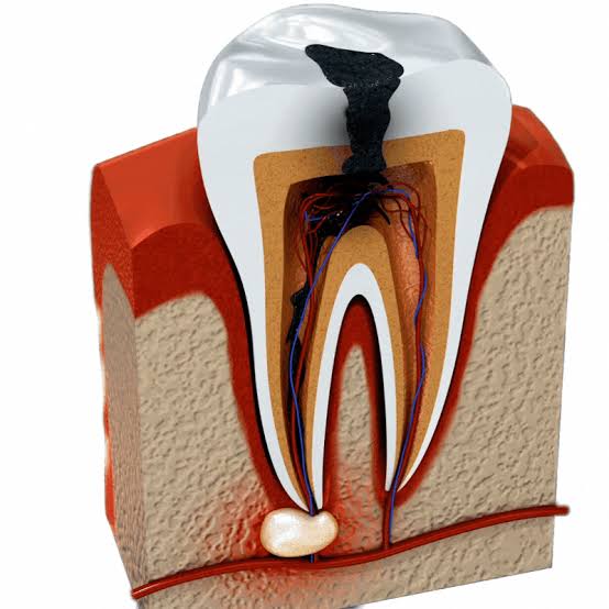 Root Canal Treatment