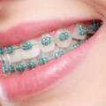 Can Adults Get Braces in Lavelle Road?