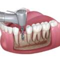 Why Is Root Canal Treatment Necessary?