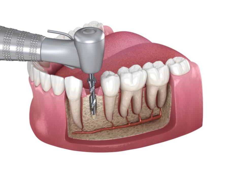 Root Canal Treatment