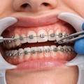 Are Braces Painful? What To Expect During the First Few Days?