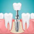 Are Dental Implants Worth It? Benefits, Risks and What to Expect?