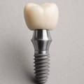 Dental Implant VS Bridge: Which is Better for a Missing Tooth?