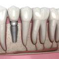 How Much Does a Dental Implant Cost in Bangalore?