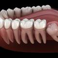 Why Should Wisdom Teeth Be Removed?