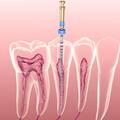Which Tooth Needs a Root Canal?