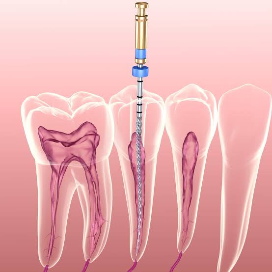 Root Canal