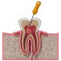 Is Root Canal Treatment Painful? What You Should Expect
