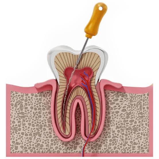 Root Canal Treatment