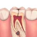 How Long Does a Root Canal Take? Single Sitting VS Multiple Visits
