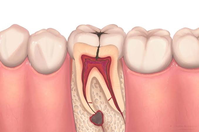 Root Canal