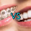Braces vs Invisalign: Which is Better for Straightening Teeth?