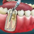 How Much Does Root Canal Treatment Cost in Bangalore?