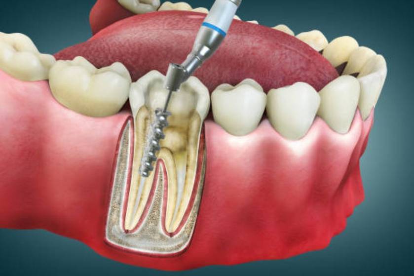 root canal treatment