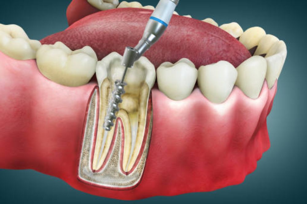 root canal treatment
